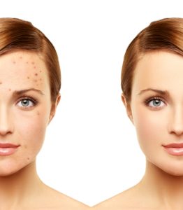 A woman with acne mirrored without acne